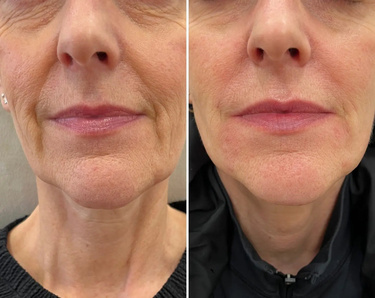 Micro-Infusion Lift Pro®