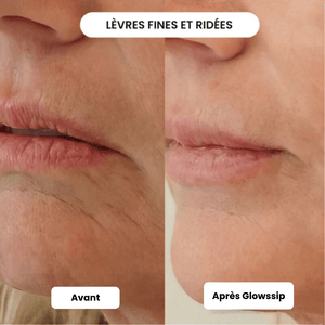 Micro-Infusion Lift PRO®