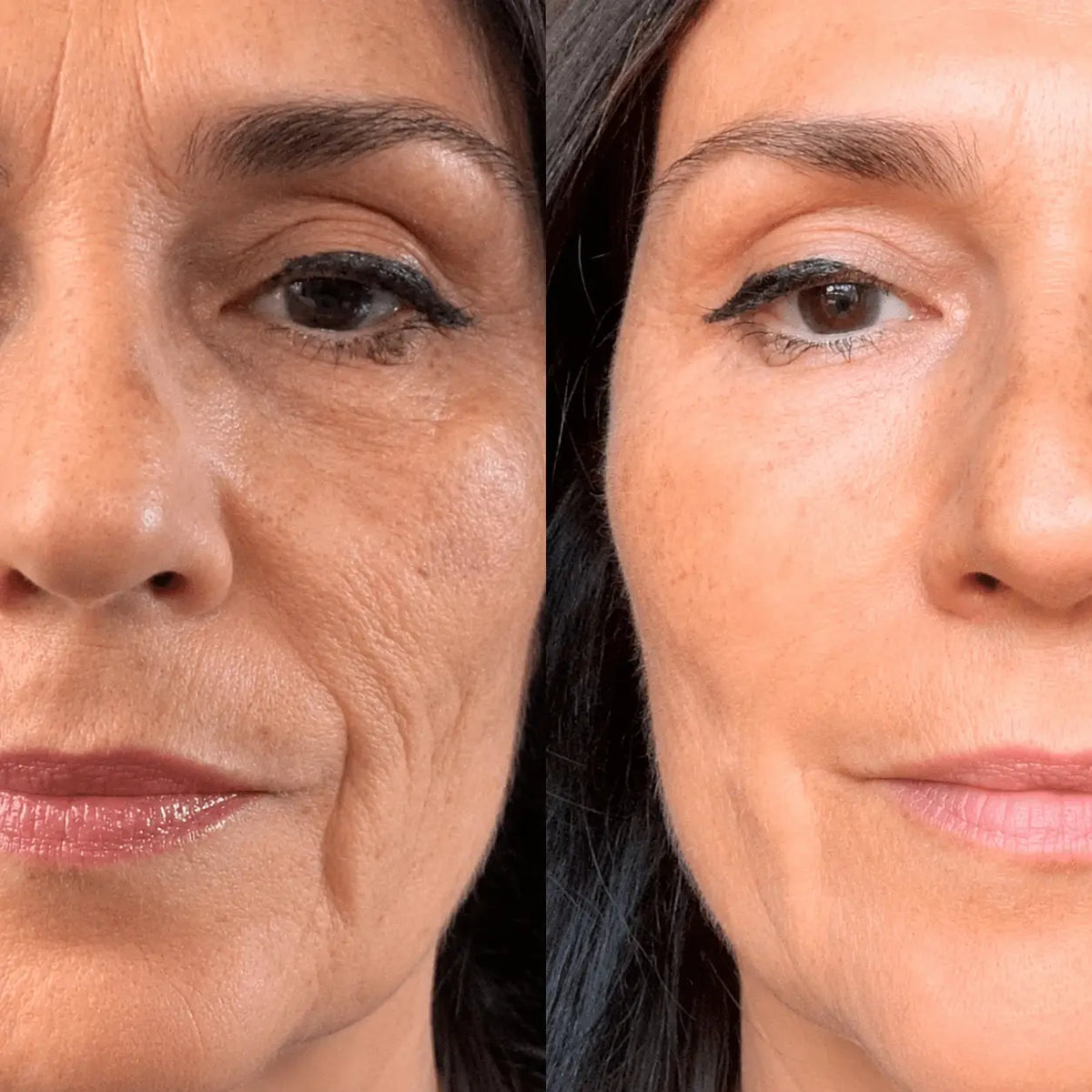 Micro-Infusion Lift Pro®