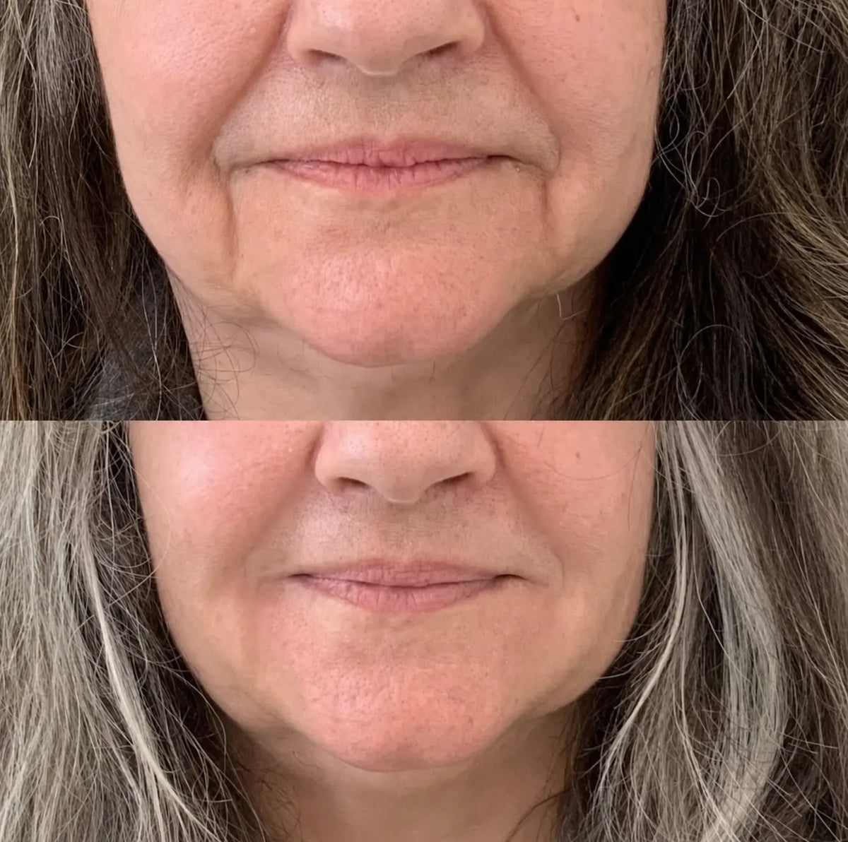 Micro-Infusion Lift Pro®
