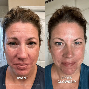 Micro-Infusion Lift Pro®