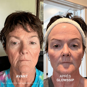 Micro-Infusion Lift PRO®