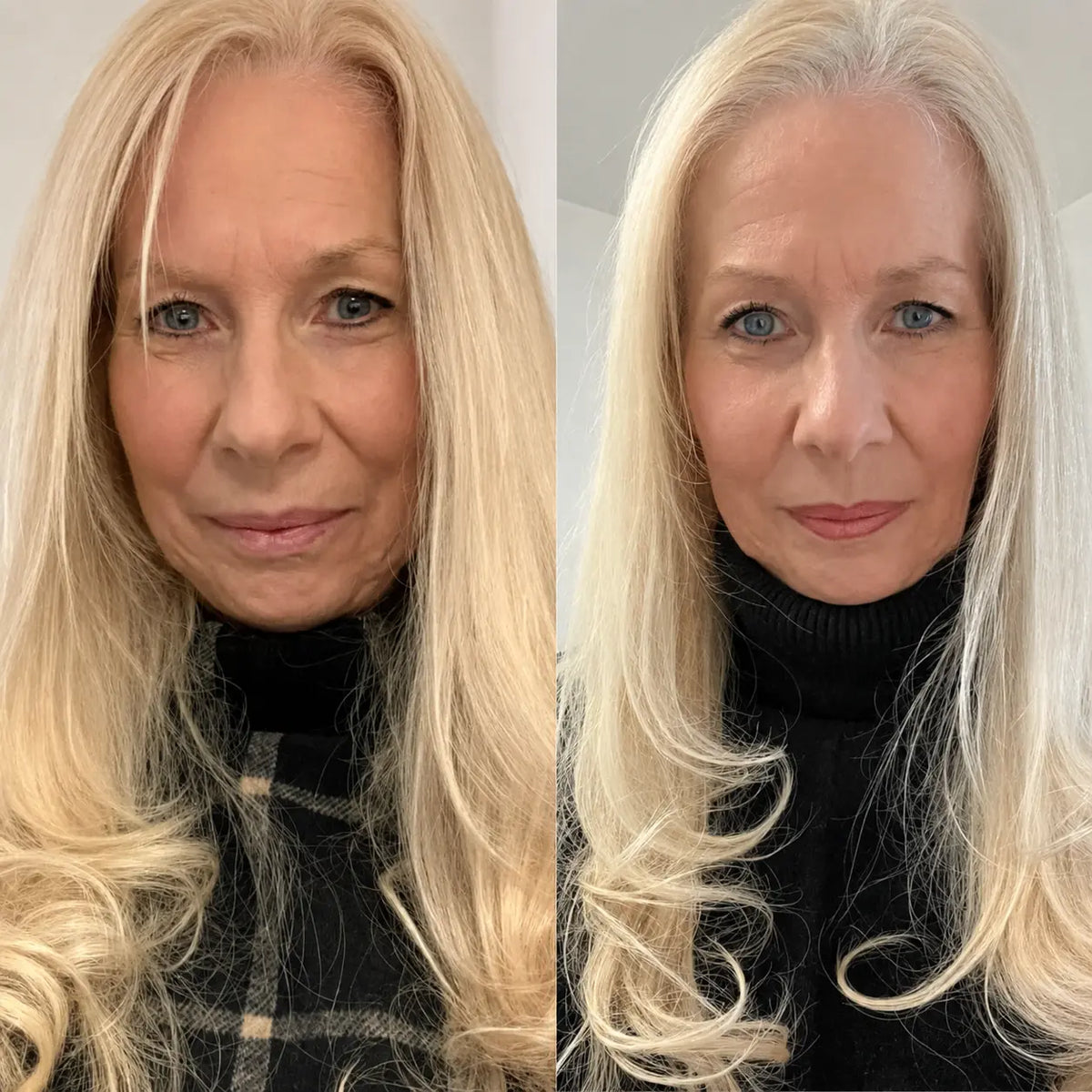 Micro-Infusion Lift Pro®